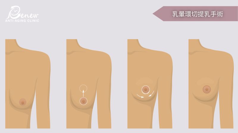 縮乳或提乳手術有幾種方式，其中也有「一兼二顧」的共享優勢