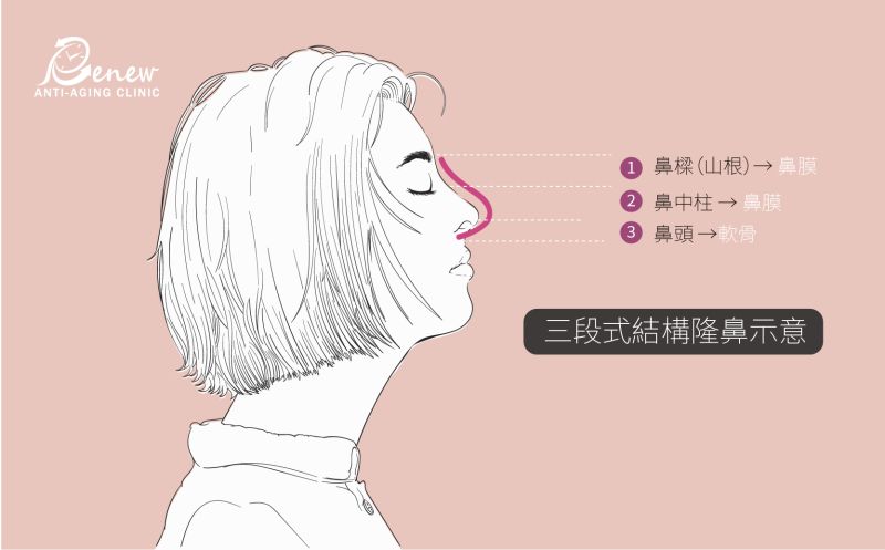鼻整形手術－三段式結構隆鼻示意圖，鼻樑（山根）－鼻膜，鼻中柱－鼻膜，鼻頭－軟骨