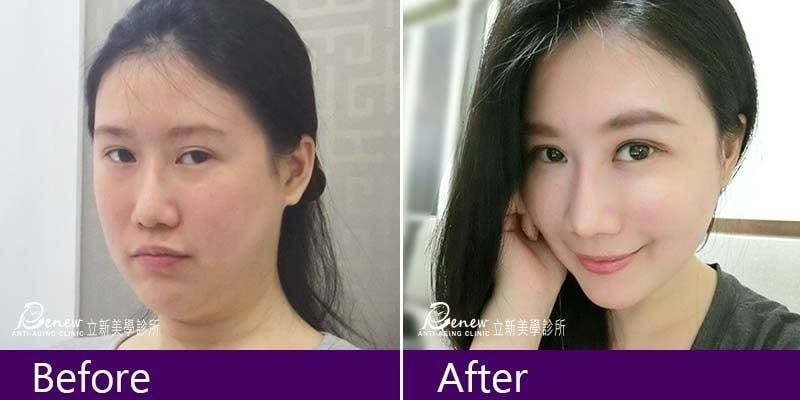 (對比圖)8字美人線特殊走法,拉提收緊雙下巴、調整下頷線,使下頷線變明顯,也一併讓下巴變得微翹