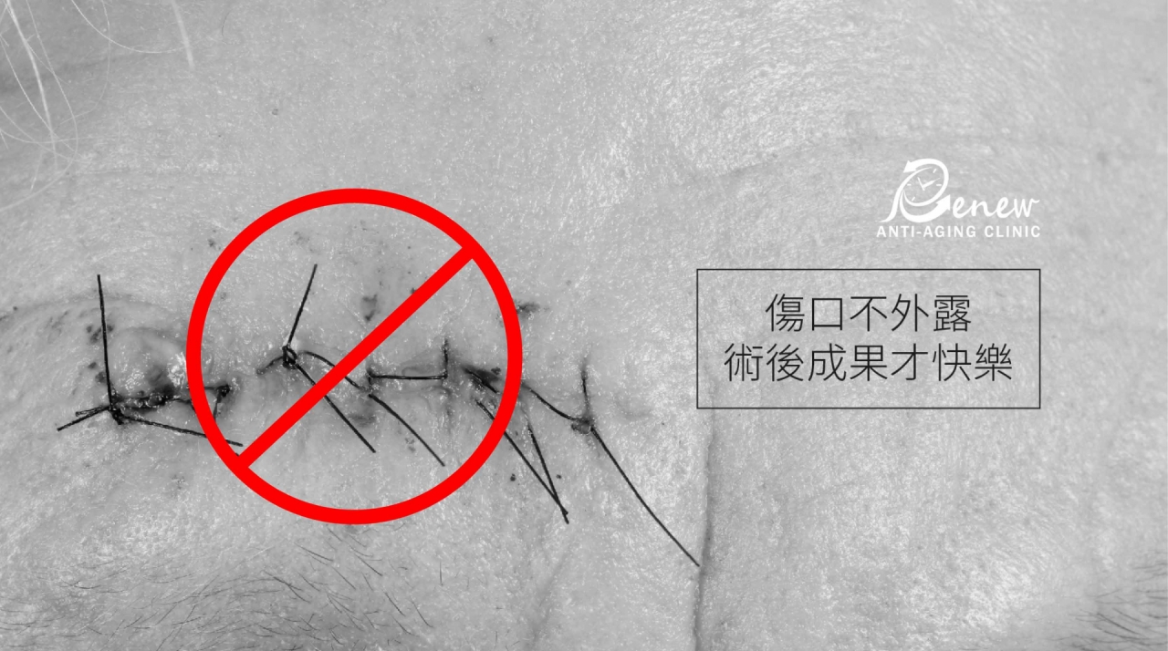 隱痕提眉眼尾：擺脫倒眉垂眼問題，回歸「亮眼」美人寶座