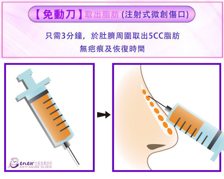 鼻整形及隆鼻靠免動刀取出脂肪(注射式微創傷口)，只需3分鐘，於肚臍周圍取出5CC脂肪無疤痕及恢復時間