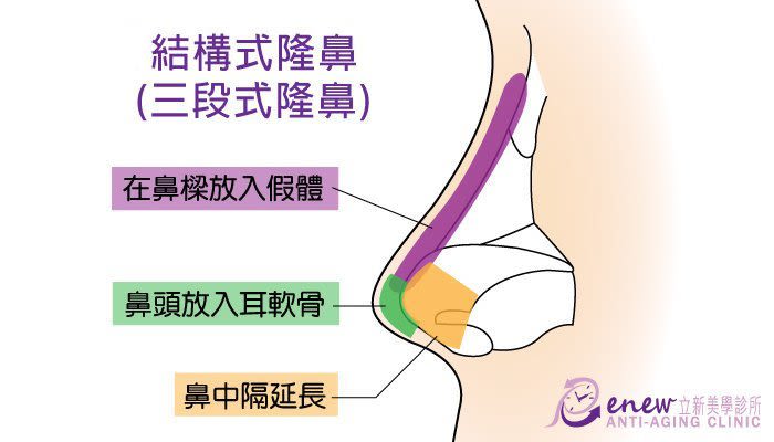 鼻整形修復二步救援，挽回9成以上受創的心靈，結構三段式隆鼻，在鼻樑放入假體，鼻頭放入耳軟骨，鼻中隔延長