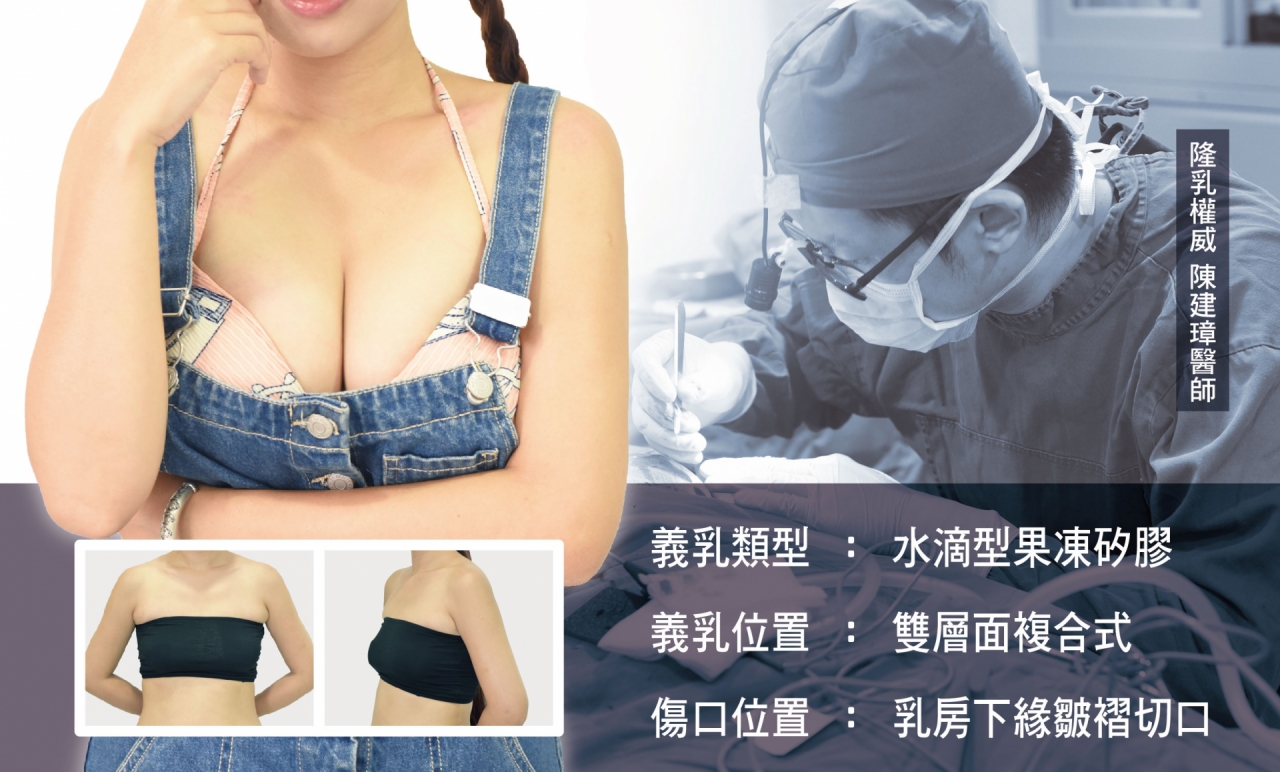 義乳的類型-水滴型果凍矽膠／義乳的位置-雙層面複合／傷口位置-乳房下緣皺褶切口，隆乳就來立新美學！