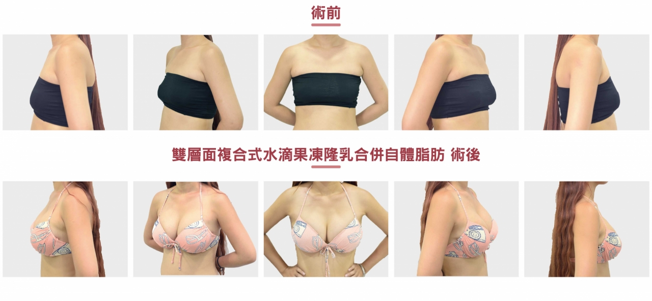 (對比圖)雙層面複合式曼陀水滴果凍隆乳合併自體脂肪-術前術後比對圖片,胸部真的變得飽滿又有彈性耶!