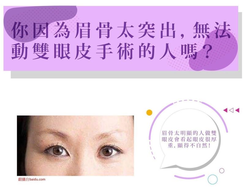 八字靚眼線解決眉骨突出無法動雙眼皮手術