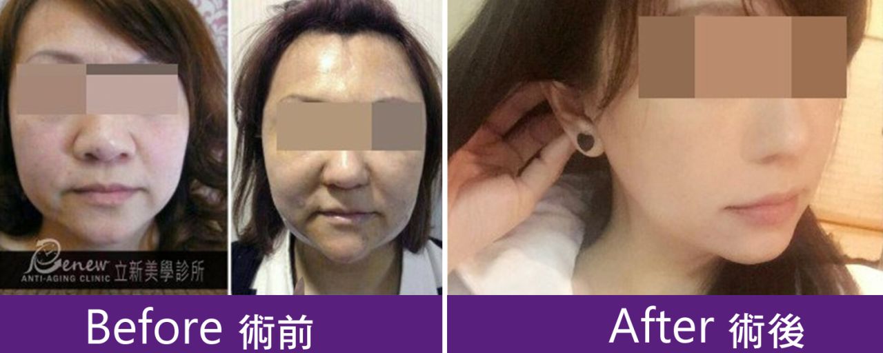 (對比圖)8字美人線可以客制符合臉型的完美弧線,拉提雙下巴,給你精緻小臉