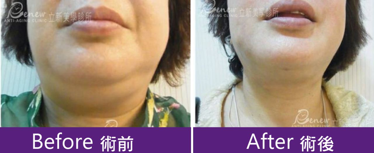 (對比圖)