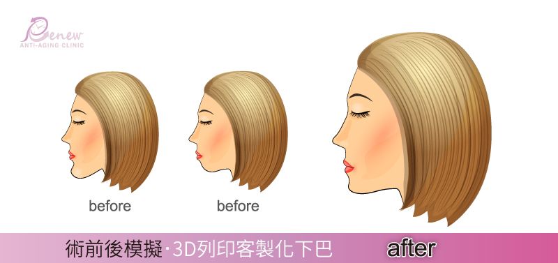 『3D列印客製化下巴』臉型要好看，就是要屬於自己的完美下巴