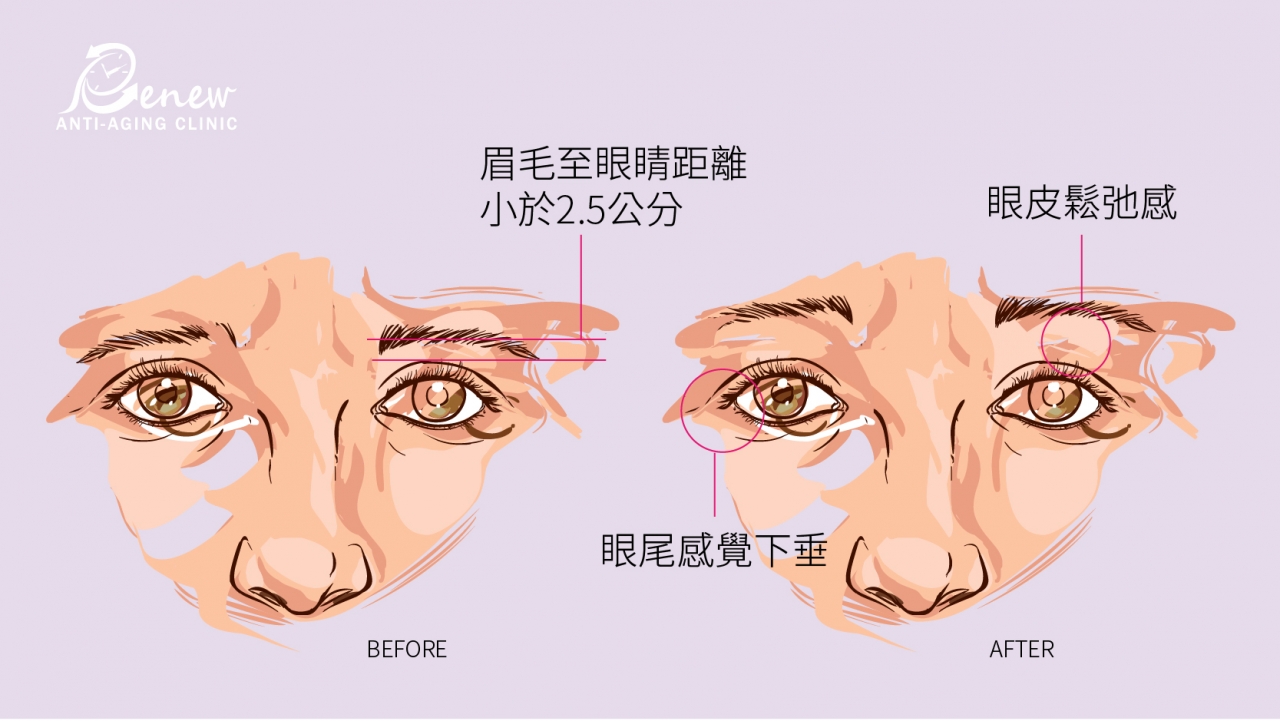 隱痕提眉眼尾：擺脫倒眉垂眼問題，回歸「亮眼」美人寶座