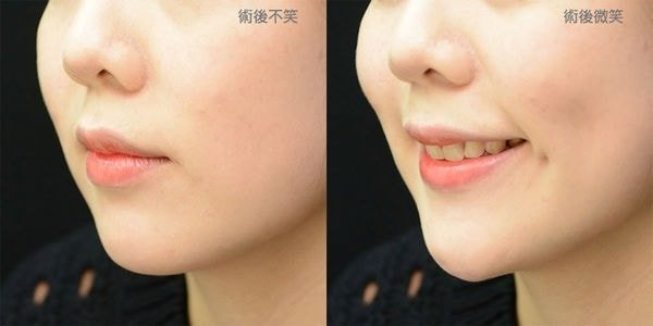 【加個梨窩，讓笑容更甜一點！ 謝氏超自然梨渦手術!，立新美學診所，術後微笑，術後不笑