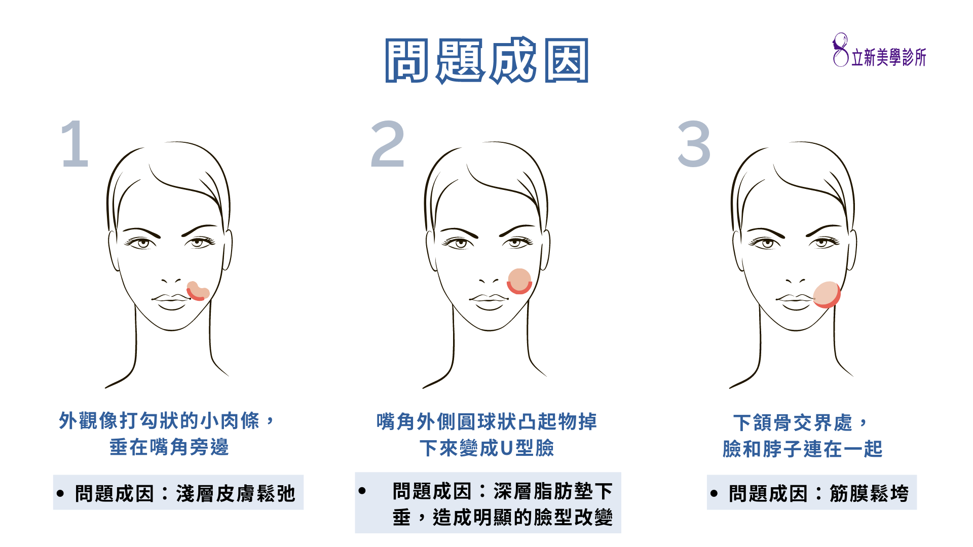問題成因 外觀像打勾狀的小肉條,垂在嘴邊旁邊 問題成因:淺層皮膚鬆弛 嘴角外側圓球狀凸起物掉下來變成U型臉 問題成因:深層脂肪墊下垂,造成明顯的臉型改變 下頷骨交界處,臉和脖子連在一起 問題成因:筋膜鬆垮