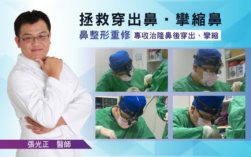 惊!越南正妹美的鼻要鼻要~凹洞鼻神再造黄金「鼻」例,手术,隆鼻,真美学诊所