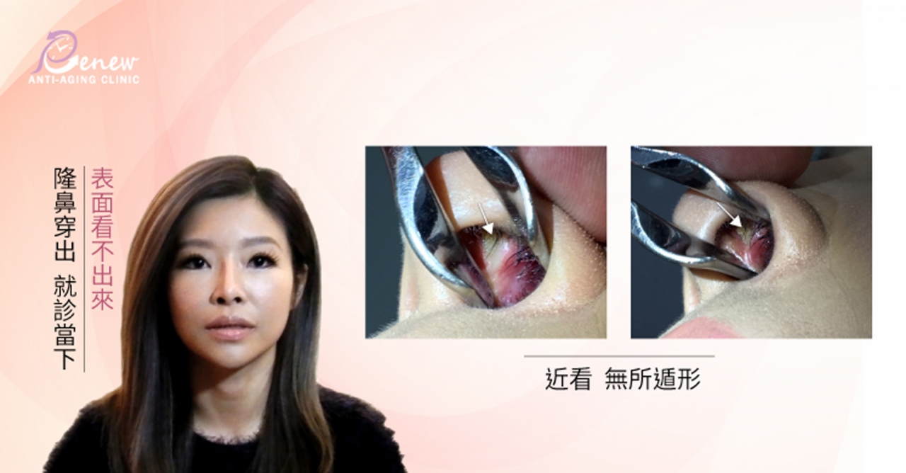 【全真自体系列-QUILL自体隆鼻(Q鼻)+安全可吸收材质撑架】五官立体高颜值 决胜点靠高挺鼻+小巧尖下巴