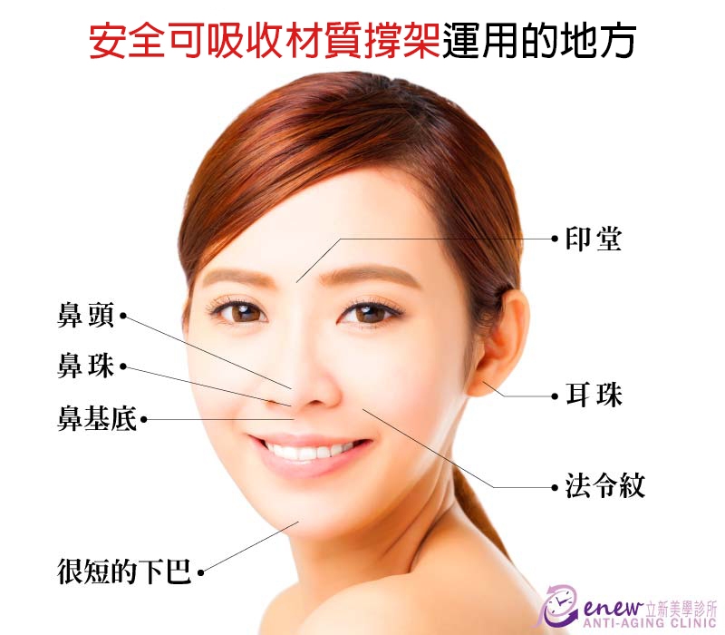 【全真自体系列-QUILL自体隆鼻(Q鼻)+安全可吸收材质撑架】五官立体高颜值 决胜点靠高挺鼻+小巧尖下巴