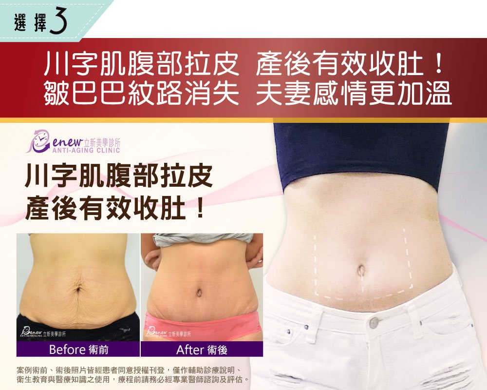 【全新8字线凋】强升8字线化腐朽为完美　免动刀效果堪比拉皮！蝴蝶袖、肚皮也帮您收紧紧，选择3，川字肌腹部拉皮，产后有效收肚，皱巴巴纹路消失，夫妻感情更加温，案例术前、术后照片皆经患者同意授权刊登，仅作辅助诊疗说明、卫生教育与医疗知识之使用，疗程前请务必经专业医师谘询及评估。川字肌腹部拉皮，产后有效收肚，案例术前、术后照片皆经患者同意授权刊登，仅作辅助诊疗说明、卫生教育与医疗知识之使用，疗程前请务必经专业医师谘询及评估。
