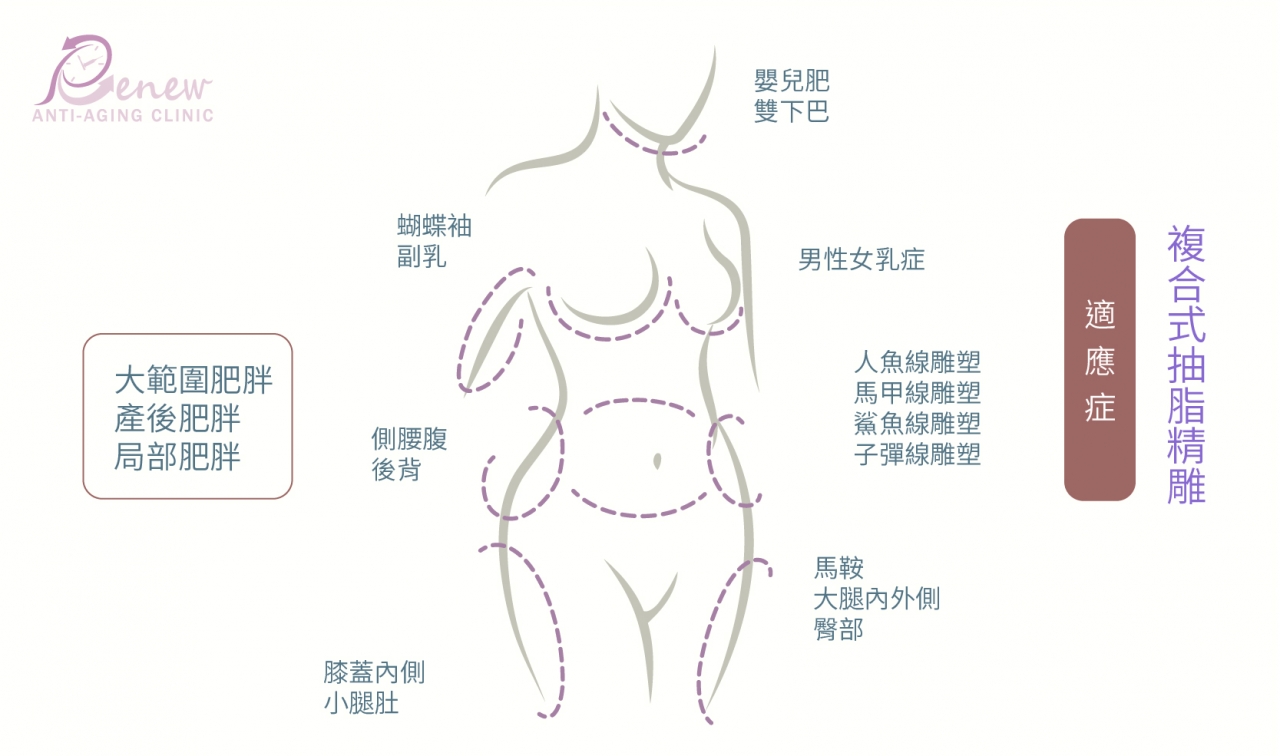 複合式抽脂精凋的适应症-大范围肥胖-产后肥胖-局部肥胖,婴儿肥/双下巴,男性女乳症,蝴蝶袖/副乳,侧腰腹/后背,膝盖内侧/小腿肚,马鞍/大腿内外侧/臀部,人鱼线凋塑/马甲线凋塑/鲨鱼线凋塑/子弹线凋塑
