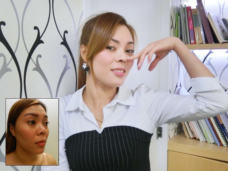 (对比图)惊!越南正妹美的鼻要鼻要~凹洞鼻神再造黄金「鼻」例,手术,隆鼻,真美学诊所,免动刀