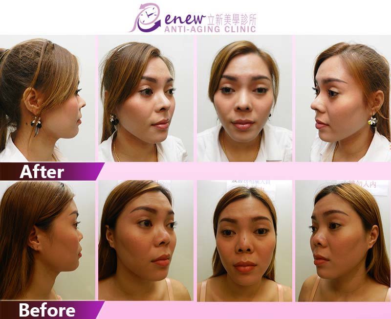 (对比图)惊!越南正妹美的鼻要鼻要~凹洞鼻神再造黄金「鼻」例,手术,隆鼻,真美学诊所,免动刀