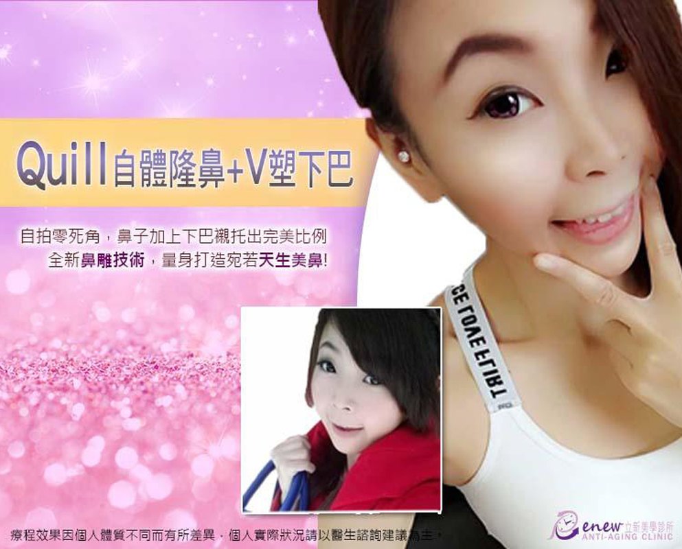 【全真自体系列-QUILL自体隆鼻(Q鼻)+安全可吸收材质撑架】五官立体高颜值 决胜点靠高挺鼻+小巧尖下巴