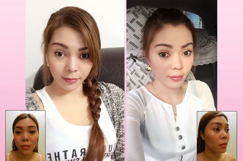 (对比图)惊!越南正妹美的鼻要鼻要~凹洞鼻神再造黄金「鼻」例,手术,隆鼻,真美学诊所,免动刀,手术,隆鼻,真美学诊所