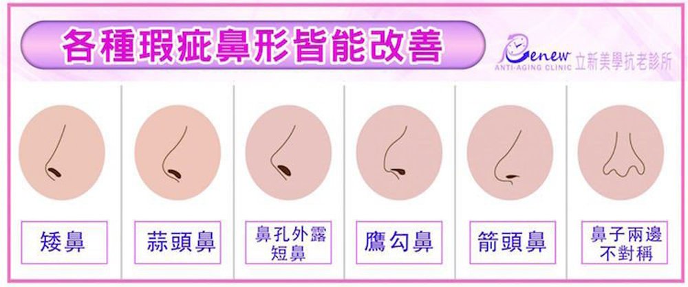 【全真自体系列-QUILL自体隆鼻(Q鼻)+安全可吸收材质撑架】各种瑕疪鼻形皆能改善
