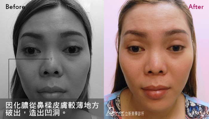 (对比图)惊!越南正妹美的鼻要鼻要~凹洞鼻神再造黄金「鼻」例,手术,隆鼻,真美学诊所