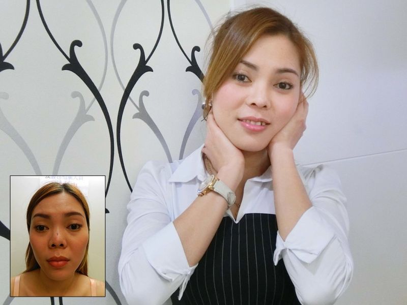 (对比图)惊!越南正妹美的鼻要鼻要~凹洞鼻神再造黄金「鼻」例,手术,隆鼻,真美学诊所,免动刀