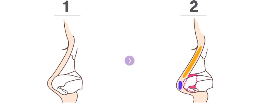 惊！越南正妹美的鼻要鼻要～凹洞鼻神再造黄金「鼻」例,手术,隆鼻,真美学诊所,免动刀,手术,隆鼻,真美学诊所