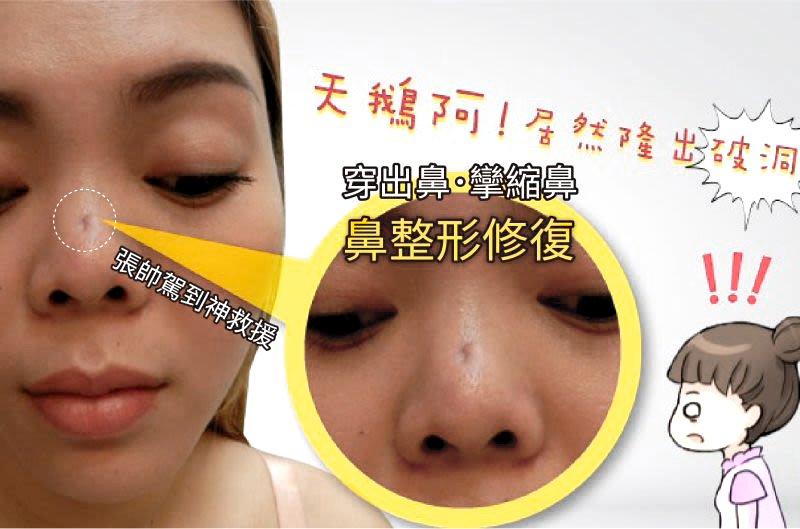 惊!越南正妹美的鼻要鼻要~凹洞鼻神再造黄金「鼻」例,手术,隆鼻,真美学诊所