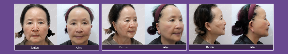 (對比圖)美麗見證,耳廓短痕三層次緊顏拉皮,術前術後照