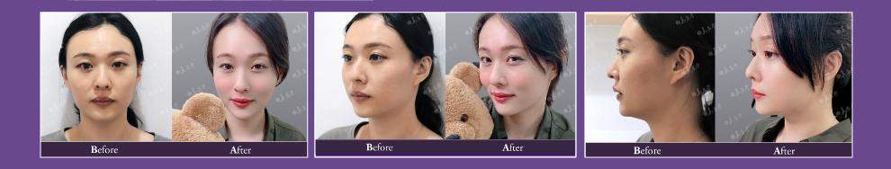 美麗見證,3代8字,術前術後照